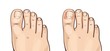 Foot herpes infections, medical illustration  