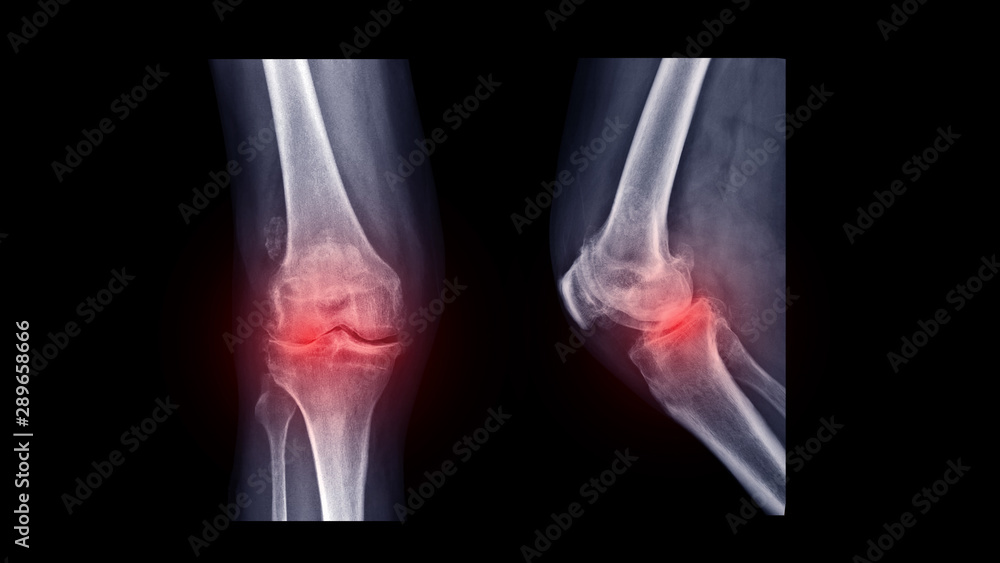 Film X-ray knee radiograph show rheumatoid arthritis disease (RA knee ...