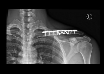 Wall Mural - film x-ray shoulder radiograph showing fracture clavicle bone after traffic accident. The patient treated by open reduction internal fixation (ORIF) with plate and screws. medical imaging concept