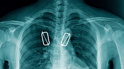 Poster - chest x-ray with scaning animation footage