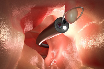 endoscope remove colonic polyp