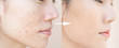 Before and After Retouch face and  Freckles  Woman  and skin problems  Facial Treatment Step