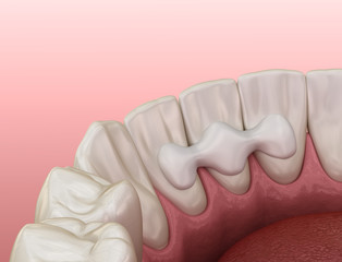 Maryland bridge made from ceramic, front tooth recovery. Medically accurate 3D illustration of dental concept