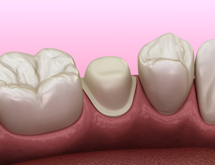 Preparated premolar tooth for dental metal-ceramic crown placement. Medically accurate 3D illustration