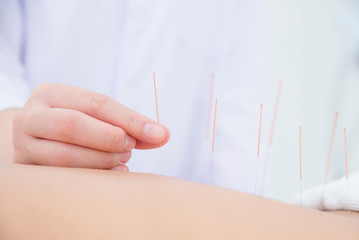 Wall Mural - Close up of hands doing acupuncture with at patient back ,Alternative medicine concept.