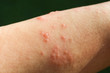 skin rash as allergic symptoms due to arm fiberglass cast