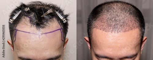 Top View Of A Man S Head With Hair Transplant Surgery With A