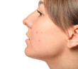 © Pixel-Shot - Young woman with acne problem on white background, closeup