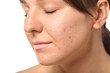 © Pixel-Shot - Young woman with acne problem on white background, closeup