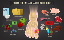 Gout Arthritis Infographic