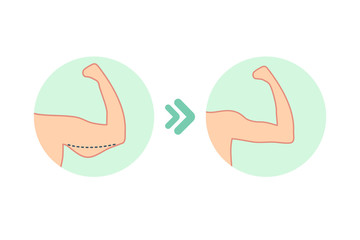 Wall Mural - Female biceps before and after sport. Vector illustration of woman body problem. Fat and slim figure, before and after weight loss. Female biceps.