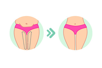 Wall Mural - Female fat hips. Woman bottoms. Flat design. Before and after diet, fitness or liposuction. Woman buttocks vector illustration. Cellulite treatment program, weight loss.