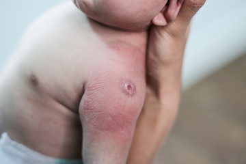 Newborn baby with red spots due to injection