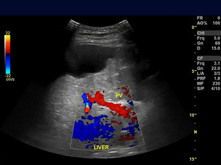 Sticker - Ultrasound upper abdomen showing flow in common bile duct  after use color Doppler.