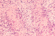 Photomicrograph of a schwannoma, a benign soft tissue tumor of peripheral nerve sheath, with characteristic nuclear palisading and 
