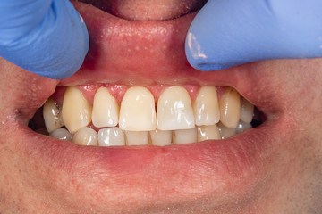 Wall Mural - filling of human teeth, close-up. Treatment with polymer fillings at the dentist’s appointment