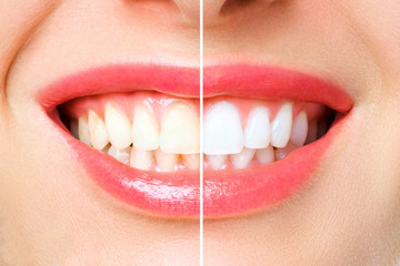 woman teeth before and after whitening. Over white background