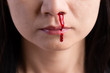 Nosebleed , a young woman with a bloody nose. Healthcare and medical concept.