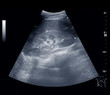 Ultrasound upper abdomen showing size of kidney