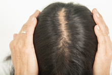 .Scalp And Thin Hair, Hair Removal Thin Hair And Scalp And Broken Hair