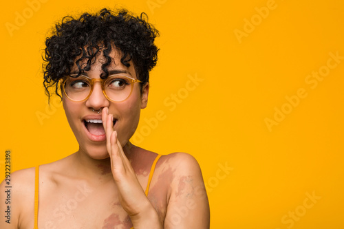 Cuadros en Lienzo Young african american woman with skin birth mark is saying a secret hot braking