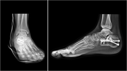 Wall Mural - Film ankle X-ray radiograph showing heel bone broken (calcaneus fracture) which treated by open reduction and internal fixation(ORIF) with plate and screws. Medical technology and instrument concept.