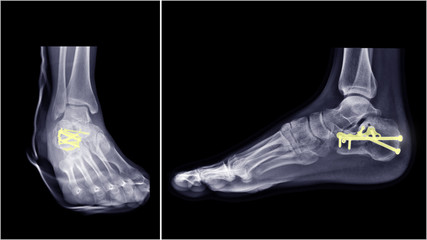 Wall Mural - Film ankle X-ray radiograph showing heel bone broken (Calcaneus fracture) which treated by surgery and fixation (ORIF) with plate and screws. Highlight on medical device and instrument.