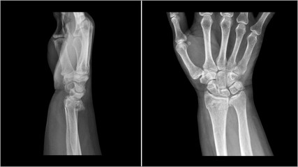 Wall Mural - Film X ray wrist radiograph show distal forearm bone broken ( distal end radius fracture). The patient has wrist pain, swelling and deformity. Medical imaging and technology concept