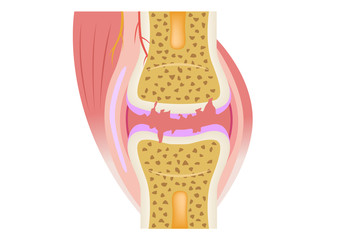 damaged joint / crack bone and osteoarthritis vector