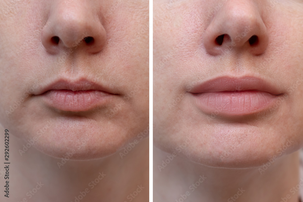Female lips before and after augmentation, the result of using hyaluronic filler - obrazy, fototapety, plakaty 