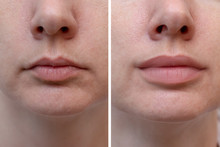 Female lips before and after augmentation, the result of using hyaluronic filler