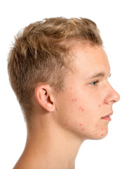 Teenage boy with acne problem on white background