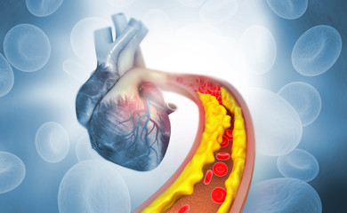 Wall Mural - Cholesterol plaque in artery with Human heart anatomy. 3d illustration