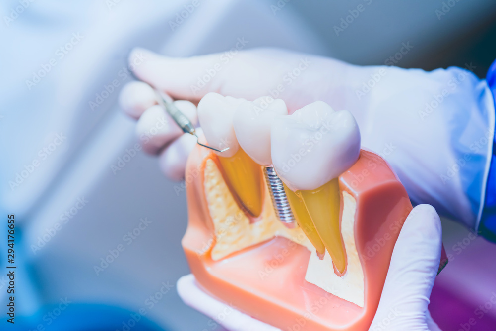 Dentist with tooth implant false teeth. Dentistry and healthcare at dental clinic.
