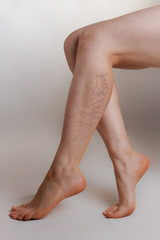 Medicine and health. The concept of female varicose veins. Female legs crossed on a white background, with a vascular star