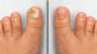 © Alessandro Grandini - Before and after successful treatment for a fungal infection on toe
