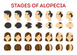 Alopecia stages set. Hair loss, balding process. Female