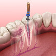 © Alex Mit - Endodontic root canal treatment process. Medically accurate tooth 3D illustration.