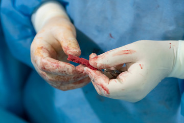 Wall Mural - Bone Autograft Close-up