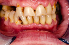 Akute Parodontitis Mit Tiefen Zahnfleischläsionen