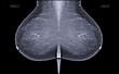 X-ray Digital Mammogram or mammography is x-ray image of the breast in women for screening  Breast cancer.