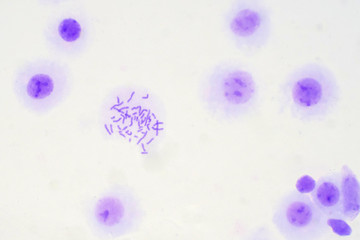 Human chromosomes from blood under microscope view.