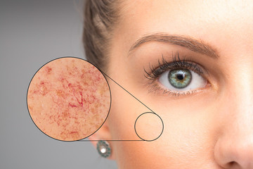 Woman face skin imperfection, capillaries in zoom circle