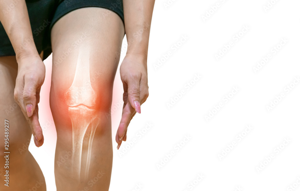 Human leg Osteoarthritis inflammation Of bone joints - obrazy, fototapety, plakaty 