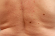 © epovdima - back of a man with many moles
