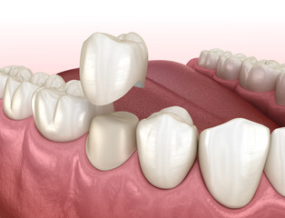 Preparated premolar tooth for dental crown placement. Medically accurate 3D illustration