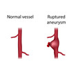 Normal vessel and ruptured aneurysm. Medical anatomy illustration.