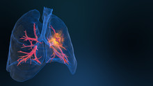 3d Rendered Illustration Of Lung Cancer 3D Illustration
