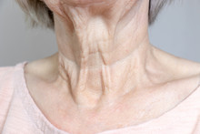 A Flabby Wrinkled Excess Skin On The Neck Of A Senior Woman Close Up