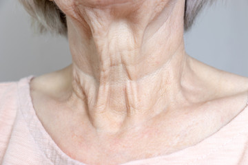 a flabby wrinkled excess skin on the neck of a senior woman close up